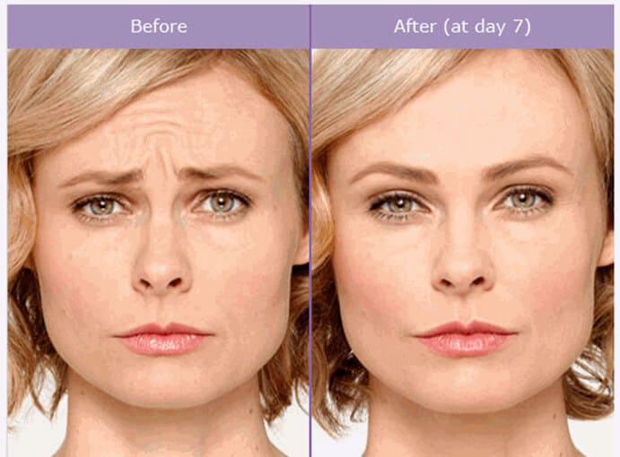 Face Botox Treatment Before & After Photos | Essence Med Spa in Grand Island & Hastings, NE