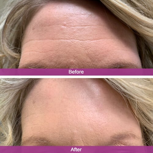Forehead Botox Treatment Before & After Photos | Essence Med Spa in Grand Island & Hastings, NE