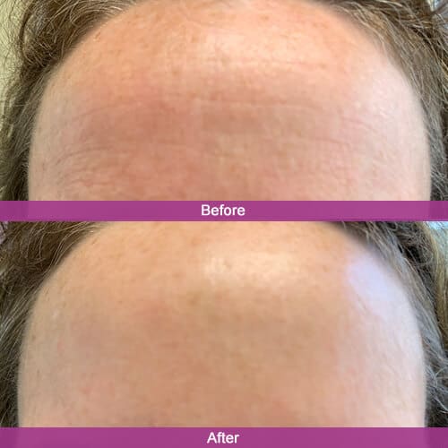 Forehead Botox Treatment Before & After Photos | Essence Med Spa in Grand Island & Hastings, NE