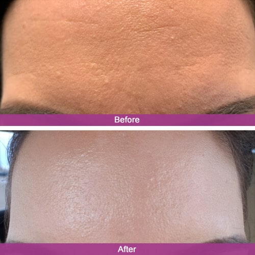 Forehead Botox Treatment Before & After Photos | Essence Med Spa in Grand Island & Hastings, NE