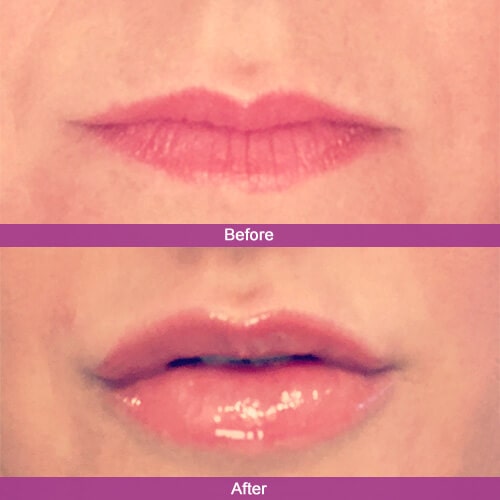 Lip Filler Before & After Photos | Essence Med Spa in Grand Island & Hastings, NE