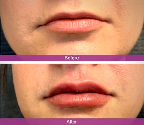 Lip Filler Before & After Photos | Essence Med Spa in Grand Island & Hastings, NE