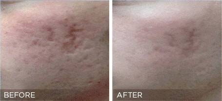 Collagen Induction Therapy Treatment Before & Photos | Essence Med Spa in Grand Island & Hastings, NE