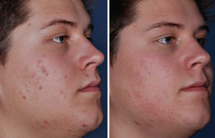Male Acne Treatment Before & after Photos | Essence Med Spa in Grand Island & Hastings, NE