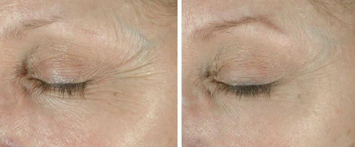 Wrinkle Treatment Before & after Photos | Essence Med Spa in Grand Island & Hastings, NE
