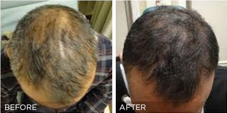 PRP Hair Restoration Treatment Before & after Photos | Essence Med Spa in Grand Island & Hastings, NE