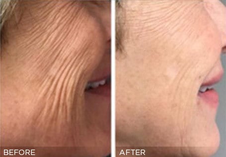 Microneedling with AnteAge MD Treatment Before & Photos | Essence Med Spa in Grand Island & Hastings, NE