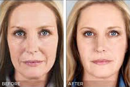 PRP Facelift Treatment Before & after Photos | Essence Med Spa in Grand Island & Hastings, NE