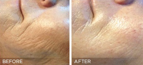 Collagen Induction Therapy Treatment Before & Photos | Essence Med Spa in Grand Island & Hastings, NE