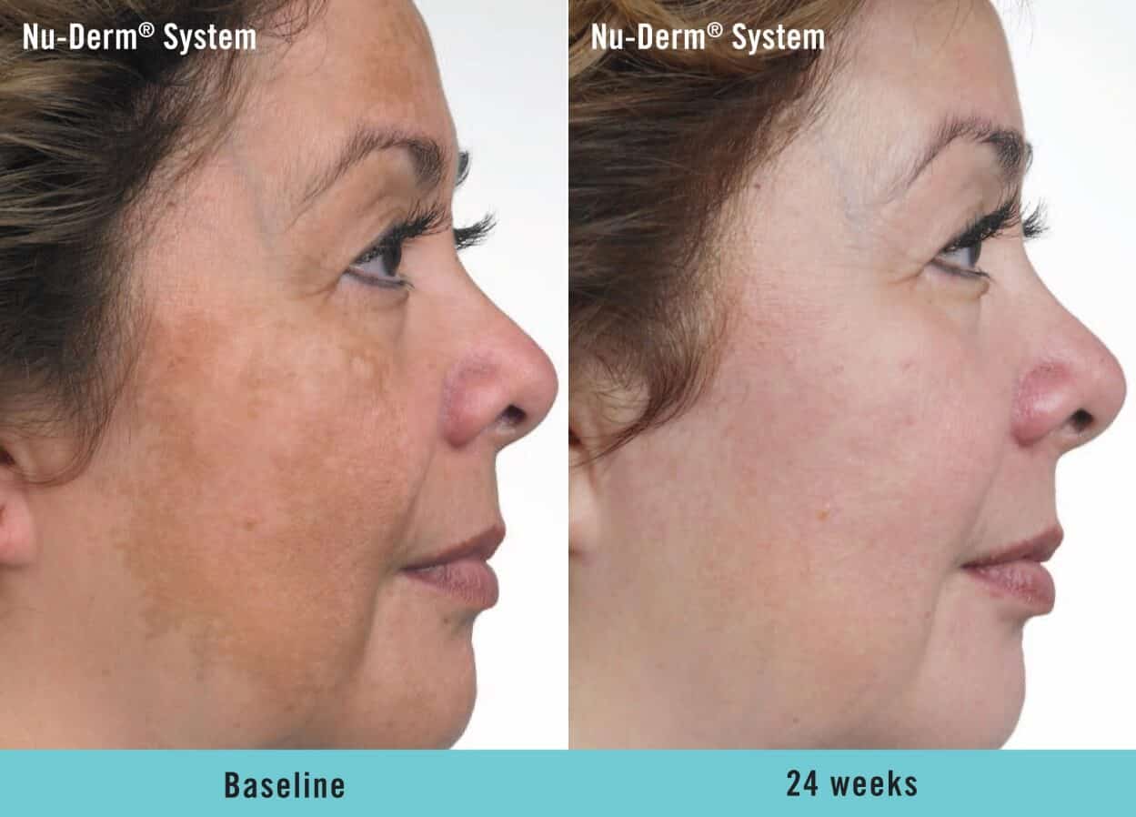Nu-Derm System Before & after 24 Weeks Treatment Photos | Essence Med Spa in Grand Island & Hastings, NE