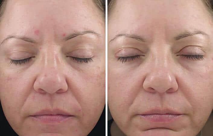 Female Acne Treatment Before & after Photos | Essence Med Spa in Grand Island & Hastings, NE