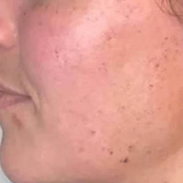 Morpheus8 Face​ After