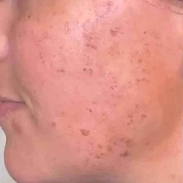 Morpheus8 Face​ Before