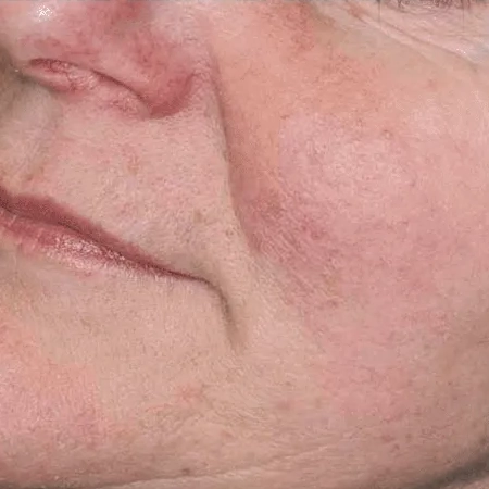 ProFractional After
