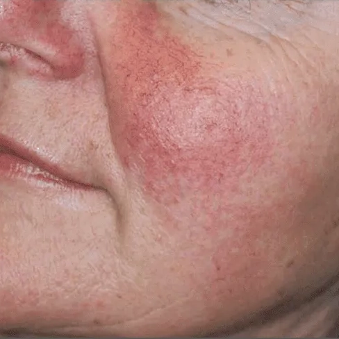 ProFractional Before