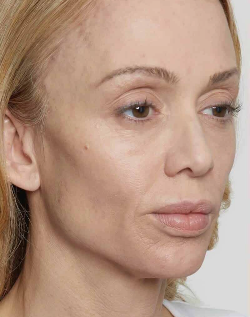 Sculptra After