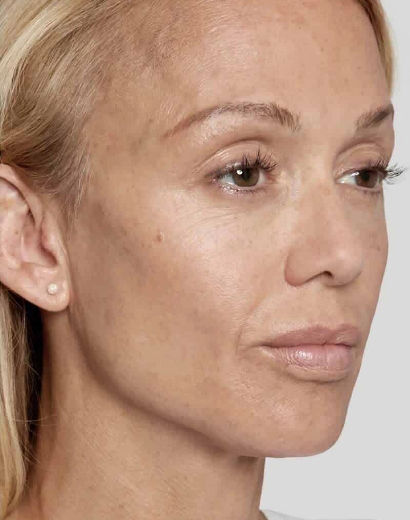 Sculptra Before