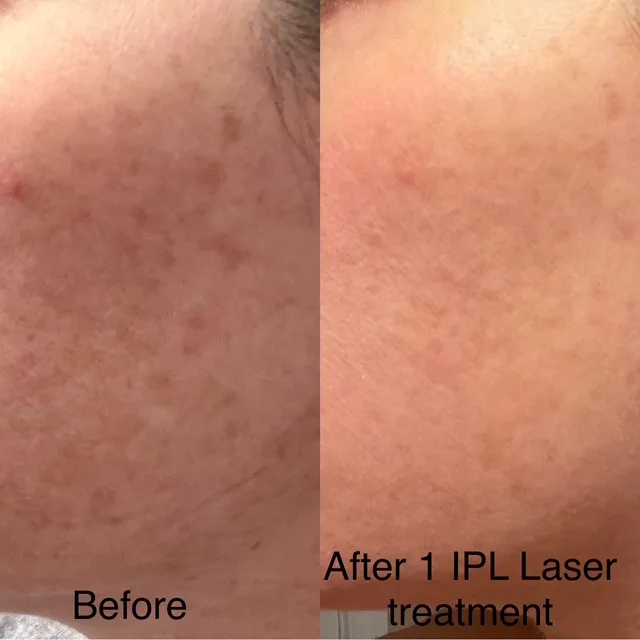 IPL BBL before After