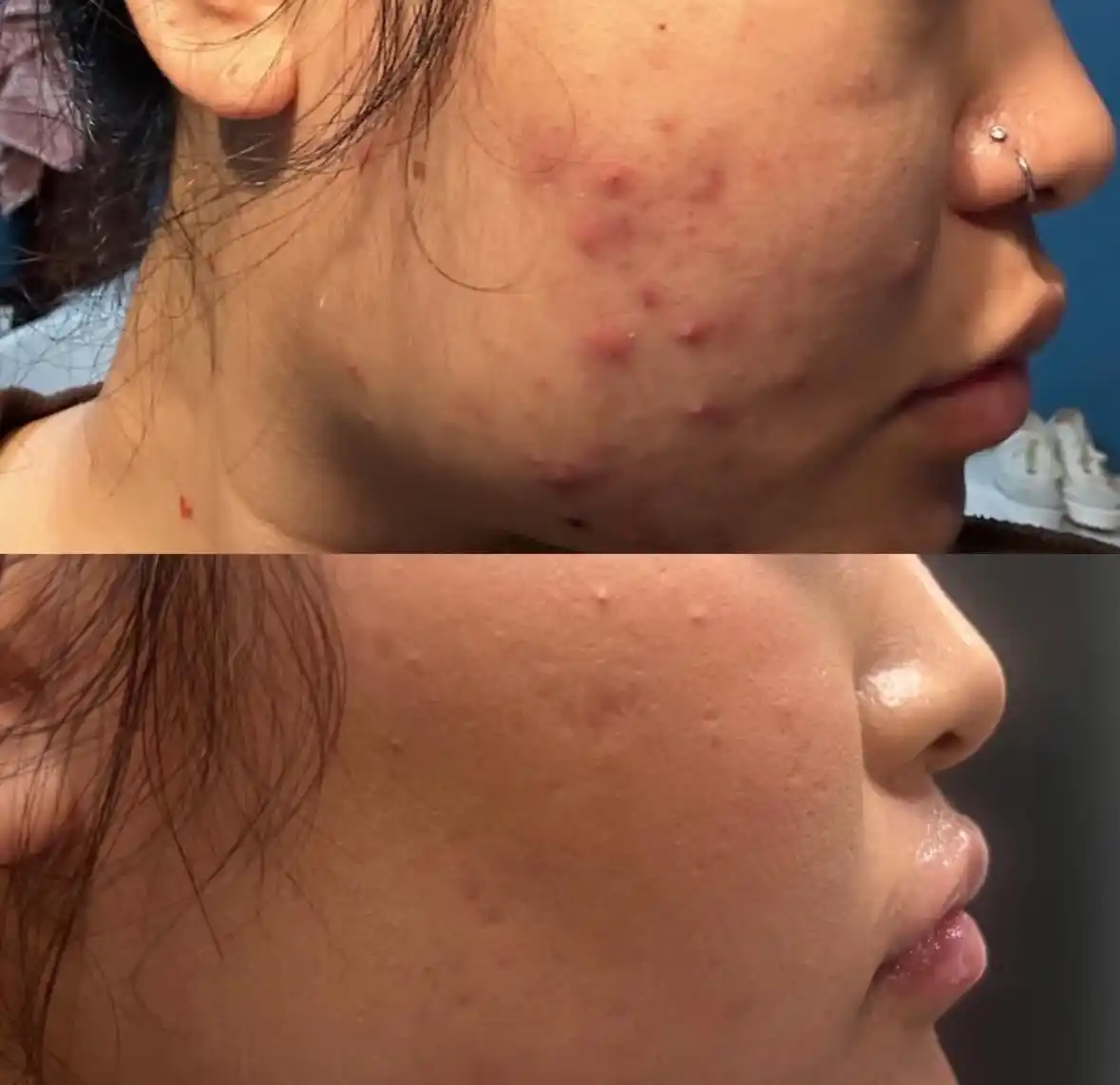 Acne 1