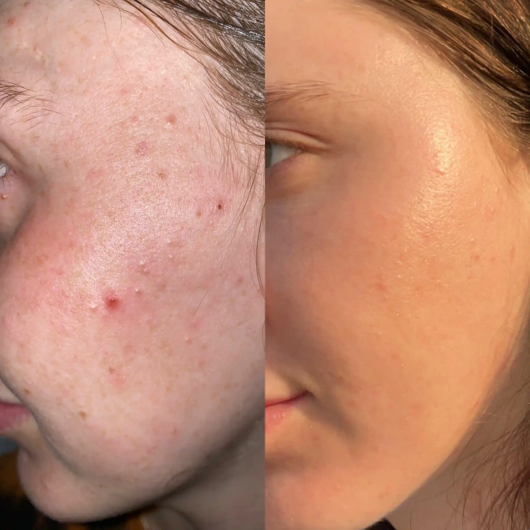 Acne 2