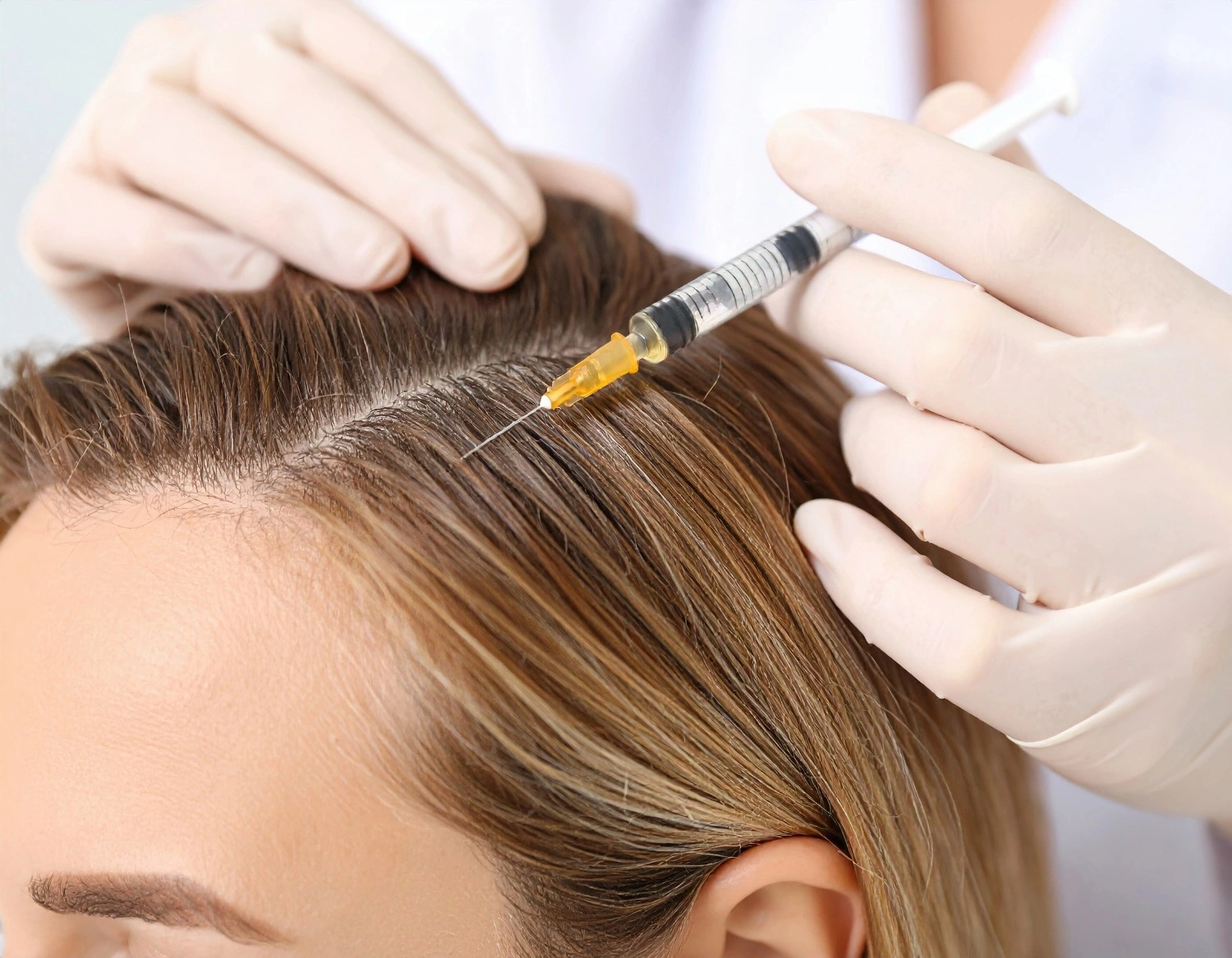 Woman Undergoing Hair Restoration Treatment at Essence Medspa