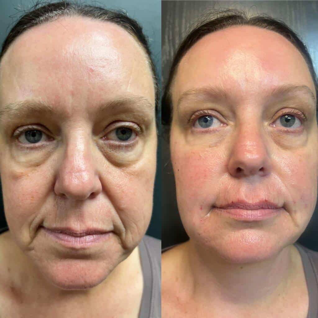 Nasolabial Folds before and after 1